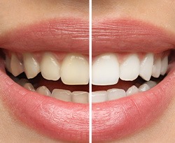 Patient's smile before and after teeth whitening treatment