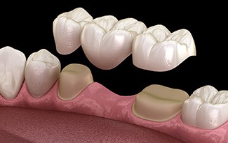 Dental bridge on a clay model