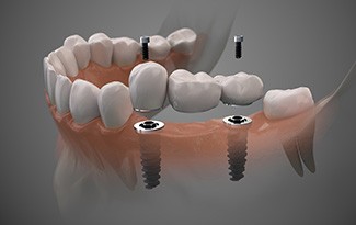 Digital illustration of a dental bridge