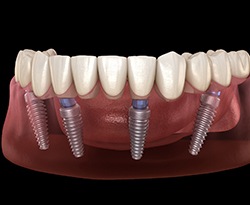 A 3D illustration of all-on-4 dental implants